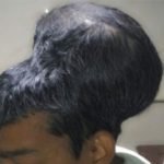වෛද්‍ය විද්‍යාවේ තවත් විස්කමක්… ලොව ලොකුම මොලයේ ගෙඩිය’ ඉවත්කරයි..