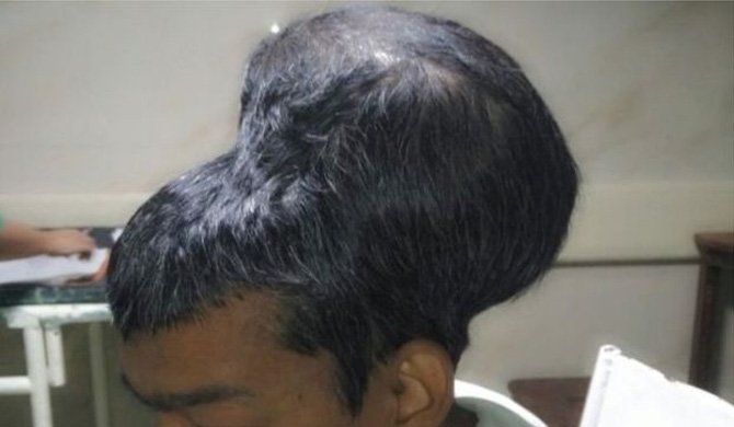 වෛද්‍ය විද්‍යාවේ තවත් විස්කමක්… ලොව ලොකුම මොලයේ ගෙඩිය’ ඉවත්කරයි..