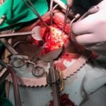 කරාපිටියේ විශේෂඥ වෛද්‍ය රංජුකගෙන් තවත් සුවිශේෂි ‘වකුගඩු සැත්කමක්‘