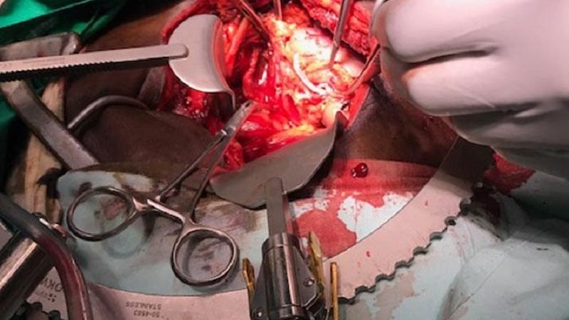 කරාපිටියේ විශේෂඥ වෛද්‍ය රංජුකගෙන් තවත් සුවිශේෂි ‘වකුගඩු සැත්කමක්‘