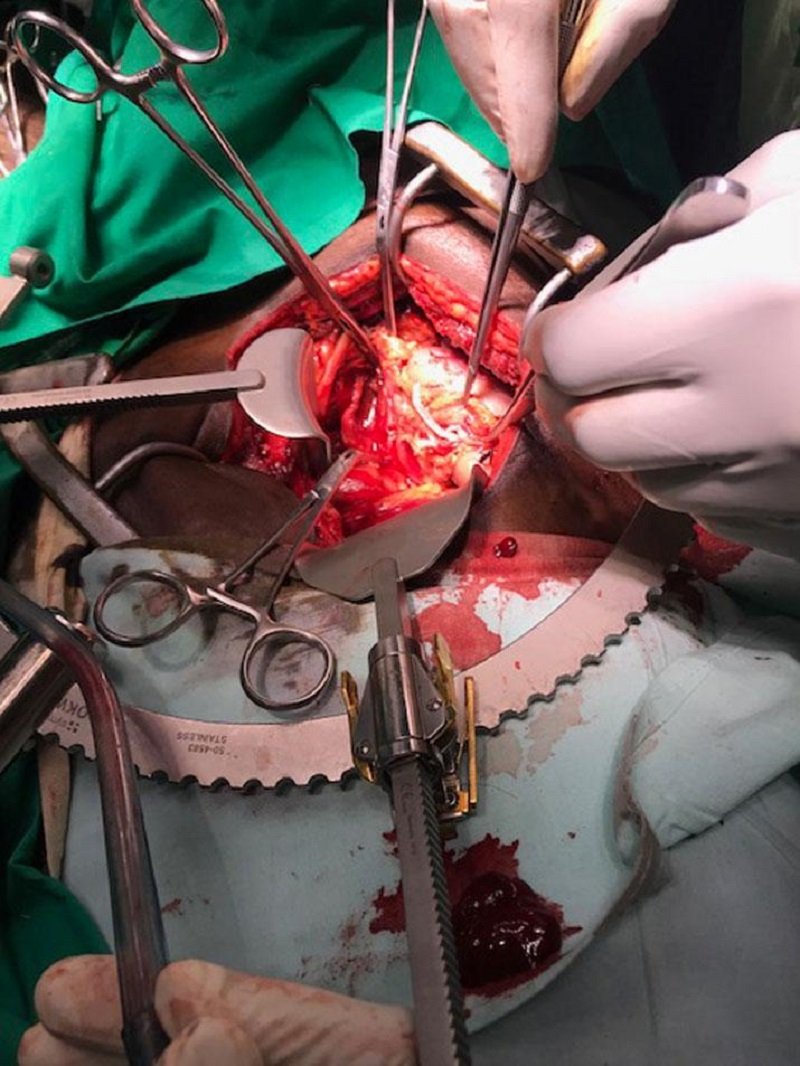 කරාපිටියේ විශේෂඥ වෛද්‍ය රංජුකගෙන් තවත් සුවිශේෂි ‘වකුගඩු සැත්කමක්‘