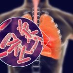 ‘ක්ෂය රෝගය’ යළි හිස ඔසවයි – වැඩිම පීඩාව කාන්තාවන්ට