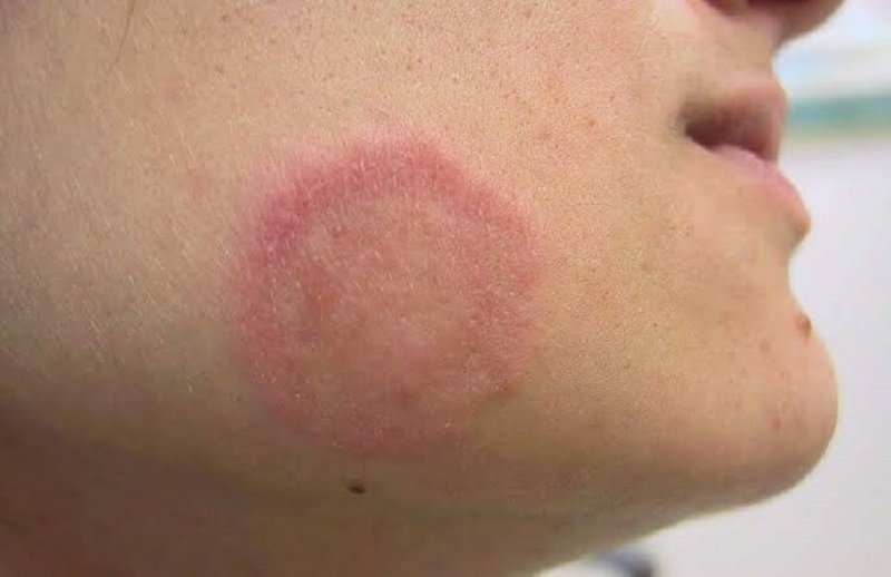 කොවිඩ් සහ ටීනියා දිලීර රෝගය අතර සෘජු සබඳතාවක් නැහැ