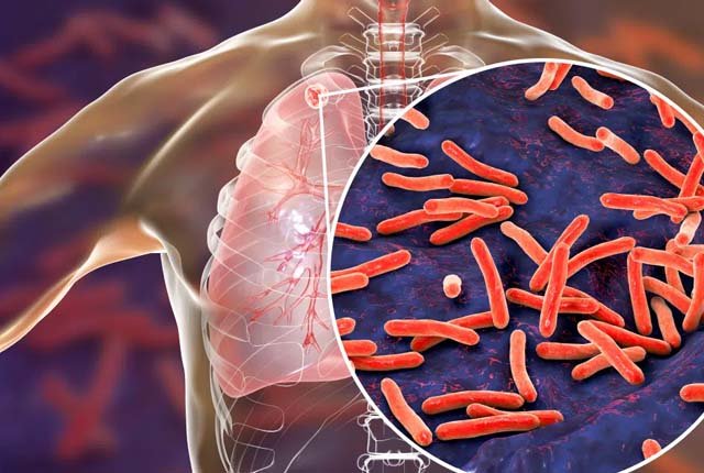 ක්ෂය රෝගීන් ගැන සෞඛ්‍ය අමාත්‍යාංශයෙන් හෙළි දරව්වක්